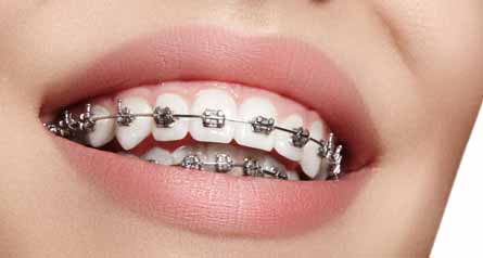 Why do You Need To Get Orthodontic Treatment