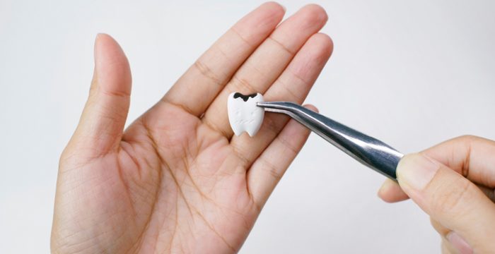 How Do Dentists Fix Cavities Between Teeth